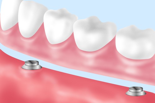 マグネットデンチャー